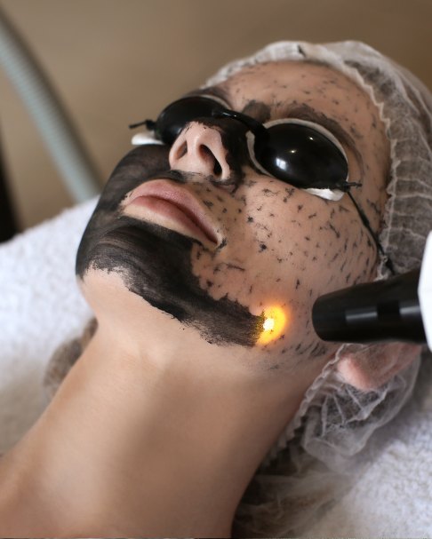 Laser Carbon Peel Procedure
